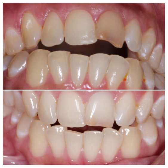 Painless Tooth Extraction in Indore Mahalaxmi Nagar 