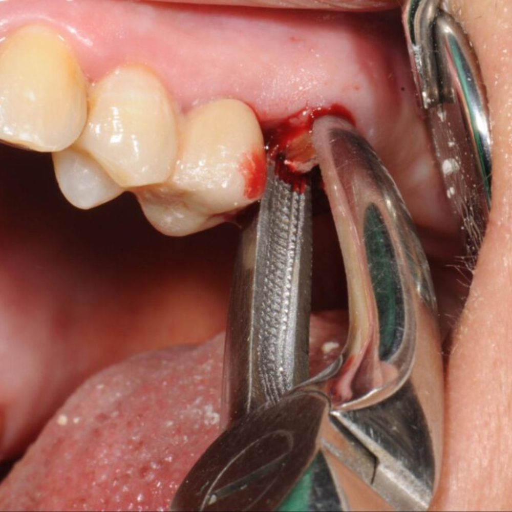 Dental Braces Treatment in Mahalaxmi Nagar Indore