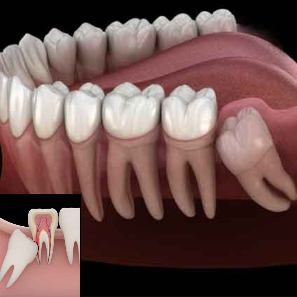 Dental Braces Treatment in Mahalaxmi Nagar Indore